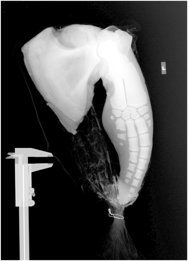 Ein Röntgenbild eines menschlichen Beins mit einer sichtbaren Fraktur in der Mitte, wahrscheinlich eine Bänderverletzung, vor schwarzem Hintergrund.